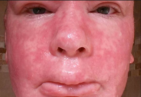 필자가 최근에 겪고 있는 피부병; 스테로이드 피부에 사용 중단 후에 오는 피부염(steroid deprivation syndrome of skin)