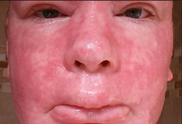  필자가 최근에 겪고 있는 피부병; 스테로이드 피부에 사용 중단 후에 오는 피부염(steroid deprivation syndrome of skin)