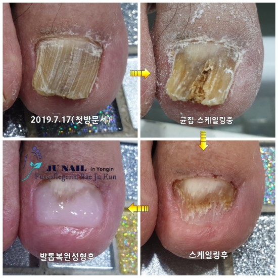발톱무좀관리시작/분당용인수원수지보정동백죽전동/주네일/무좀파고드는내향성발톱전문네일샵 발톱무좀관리시작/분당용인수원수지보정동백죽전동/주네일/무좀파고드는내향성발톱전문네일샵