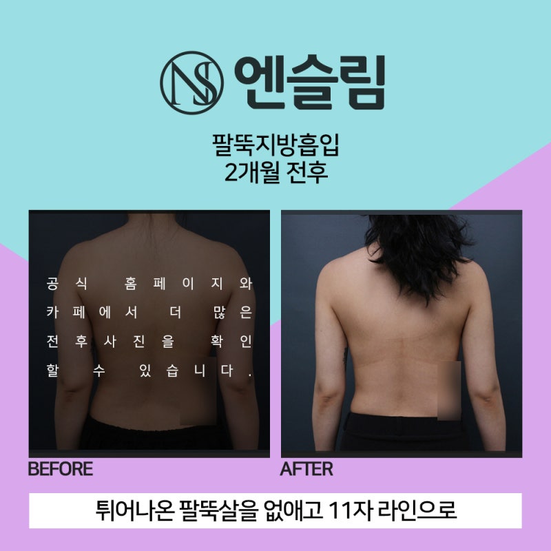 퀵바비로 팔 지방흡입 수술 비용 알아보기 *리뷰*