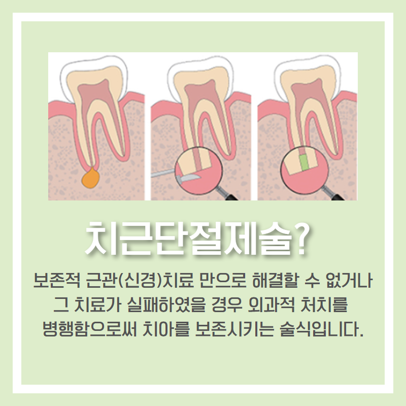 치근 단절제술 후기 치근 단절제술 후기