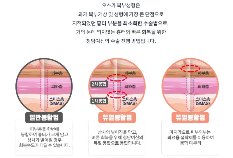 복부성형 후기가 많은 곳의 이유는 뭘까?