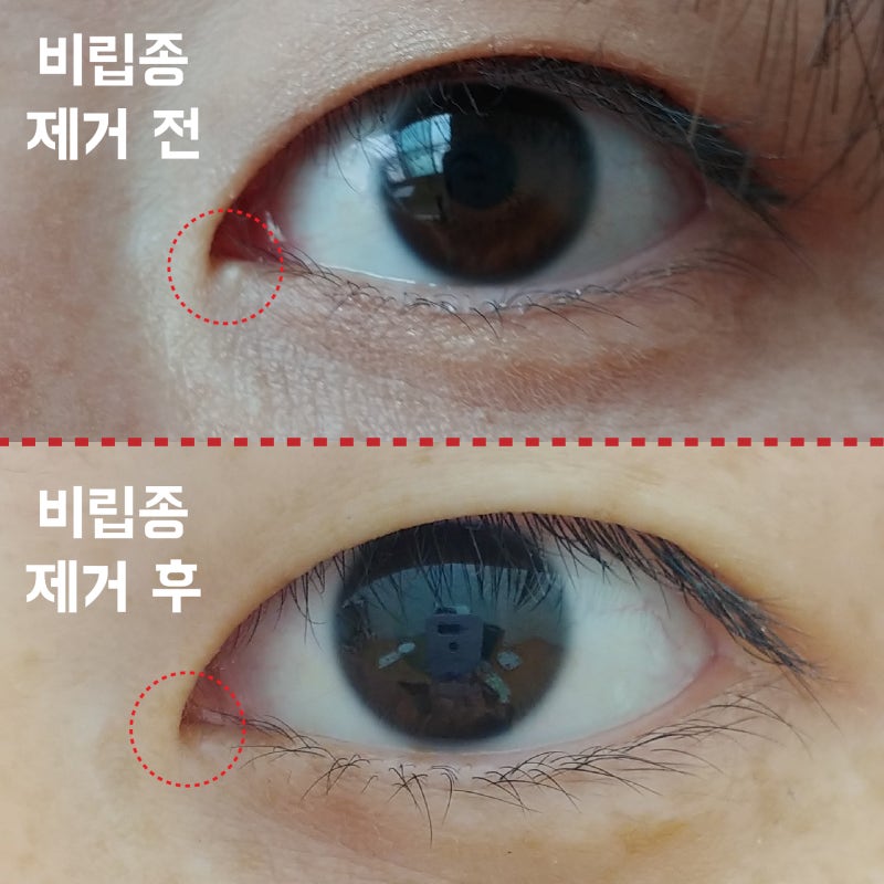 안과에서 눈앞머리쪽 비립종 제거 후기