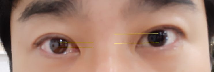  비문증 / 망막열공 - 레이저 치료 후기