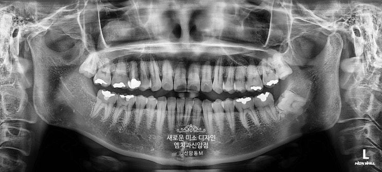  대구임플란트추천 한개를 심어도 제대로 심자!
