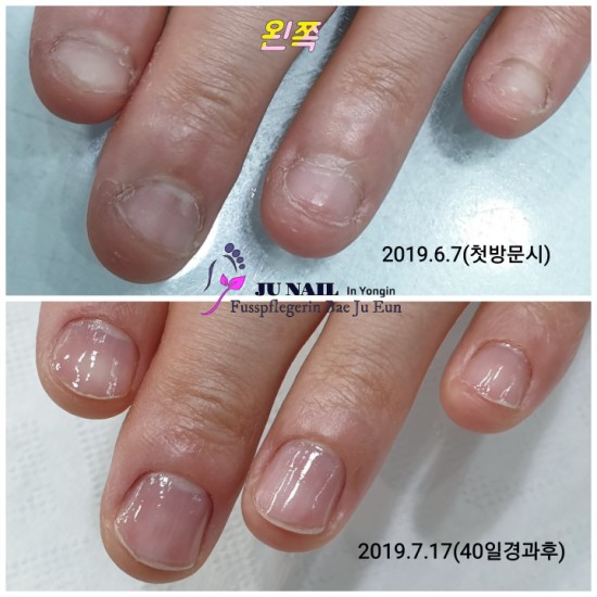 물어뜯는손톱교정 2번만에 2배로 자랐어요./분당용인수원수지보정동백죽전동/주네일/물어뜯는손톱무좀파고드는내향성발톱전문네일샵 물어뜯는손톱교정 2번만에 2배로 자랐어요./분당용인수원수지보정동백죽전동/주네일/물어뜯는손톱무좀파고드는내향성발톱전문네일샵