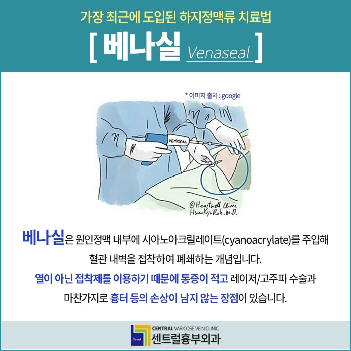 강남 하지정맥류 베나실 치료, 비열의 특징 및 효과