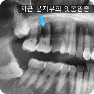  치주치료(스케일링/치주소파술/치근활택술 등등)