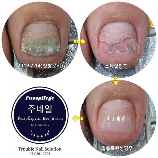 스티커네일붙인후 손톱 조갑박리(녹농균)생겼어요. /분당용인수원수지보정동백죽전동/주네일/문제성손발톱무좀파고드는내향성발톱전문네일샵 스티커네일붙인후 손톱 조갑박리(녹농균)생겼어요. /분당용인수원수지보정동백죽전동/주네일/문제성손발톱무좀파고드는내향성발톱전문네일샵