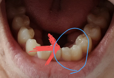 [쌍생치 융합치 교정] 치아 형태 이상인 경우의 교정치료