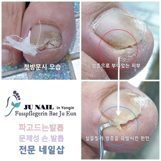 잘못깍은 발톱으로 염증이 생겼어요. 뾰족한발톱 어쩌면좋을까요 /분당용인수원수지보정동백죽전동/주네일/무좀파고드는내향성발톱전문네일샵 잘못깍은 발톱으로 염증이 생겼어요. 뾰족한발톱 어쩌면좋을까요 /분당용인수원수지보정동백죽전동/주네일/무좀파고드는내향성발톱전문네일샵