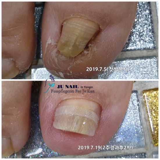 방치하고 참기만한 파고드는 심한염증발톱 어쩐단말입니까. /분당용인수원수지보정동백죽전동/주네일/무좀파고드는내향성발톱전문네일샵 방치하고 참기만한 파고드는 심한염증발톱 어쩐단말입니까. /분당용인수원수지보정동백죽전동/주네일/무좀파고드는내향성발톱전문네일샵
