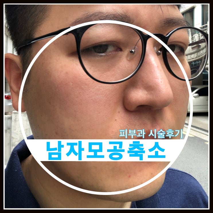 남자 모공축소 시술 DRT레이저 엑셀v레이저 시술 후기 남자 모공축소 시술 DRT레이저 엑셀v레이저 시술 후기
