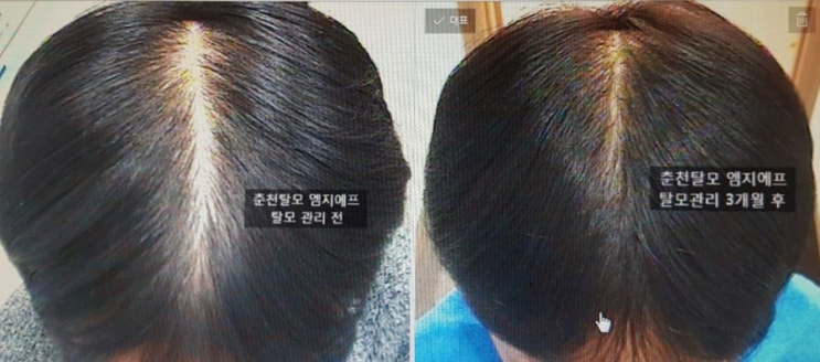 탈모관리-20대 초반 남성탈모  관리 전,후 비교(3개월)
