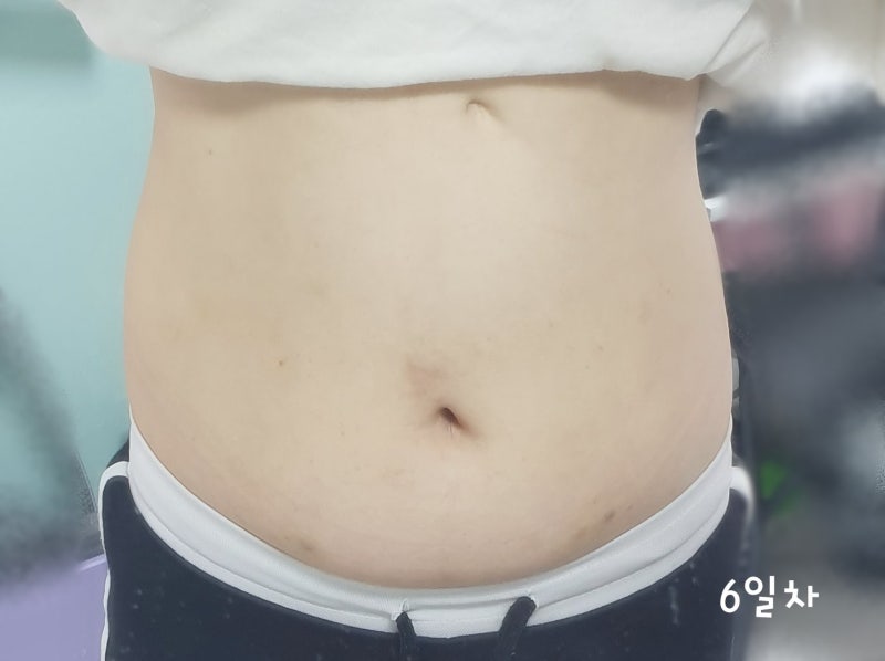 복부지방분해주사 최종 리뷰를 덤으로 옆구리 지방을 줄이는 효과까지 7
