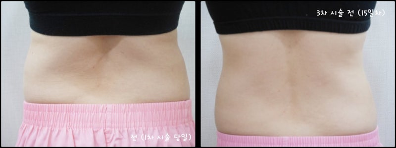 복부지방분해주사 최종 리뷰를 덤으로 옆구리 지방을 줄이는 효과까지 6