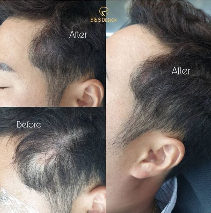  청주두피문신,탈모타투,탈모커버 비앤에스디자인