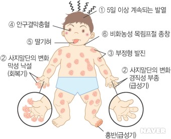  소아 가와사키병 치료에 처방되는 아스피린