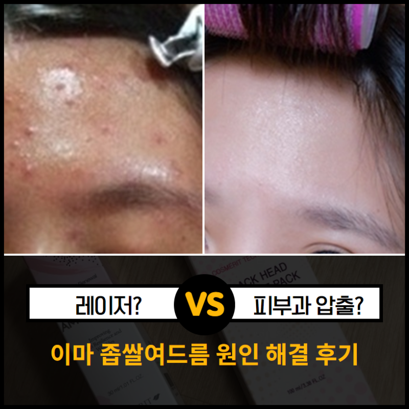 이마 좁쌀여드름 원인 해결한 후기