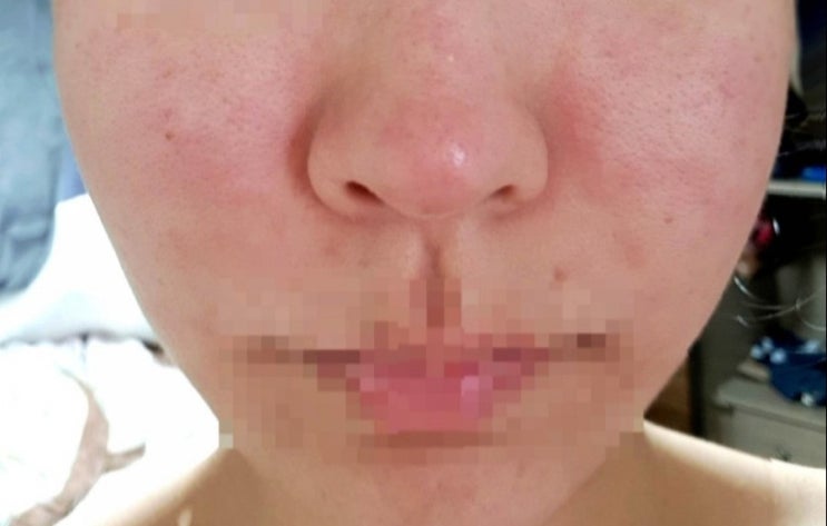  피부 뒤집어졌을때 이렇게! 10년 비법 대공개