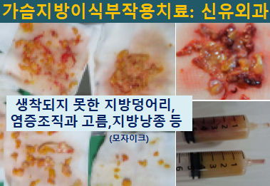  〔신유외과〕 가슴지방이식부작용치료: 지방이식부작용으로 급성염증 생겨서 오신 분