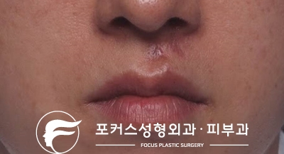  [부천성형외과 Dr. 김 칼럼] 인중의 상처 / 흉터