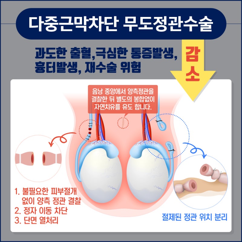 정관수술 후 정자와 정액의 변화는 무엇인가요? 세포 사멸과 식균 작용의 차이점 3