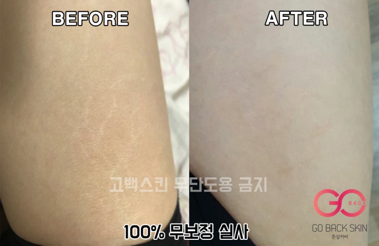  [고백스킨] 튼살타투 하얀튼살 여자 허벅지 튼살 커버 전체 과정 및 후기사진