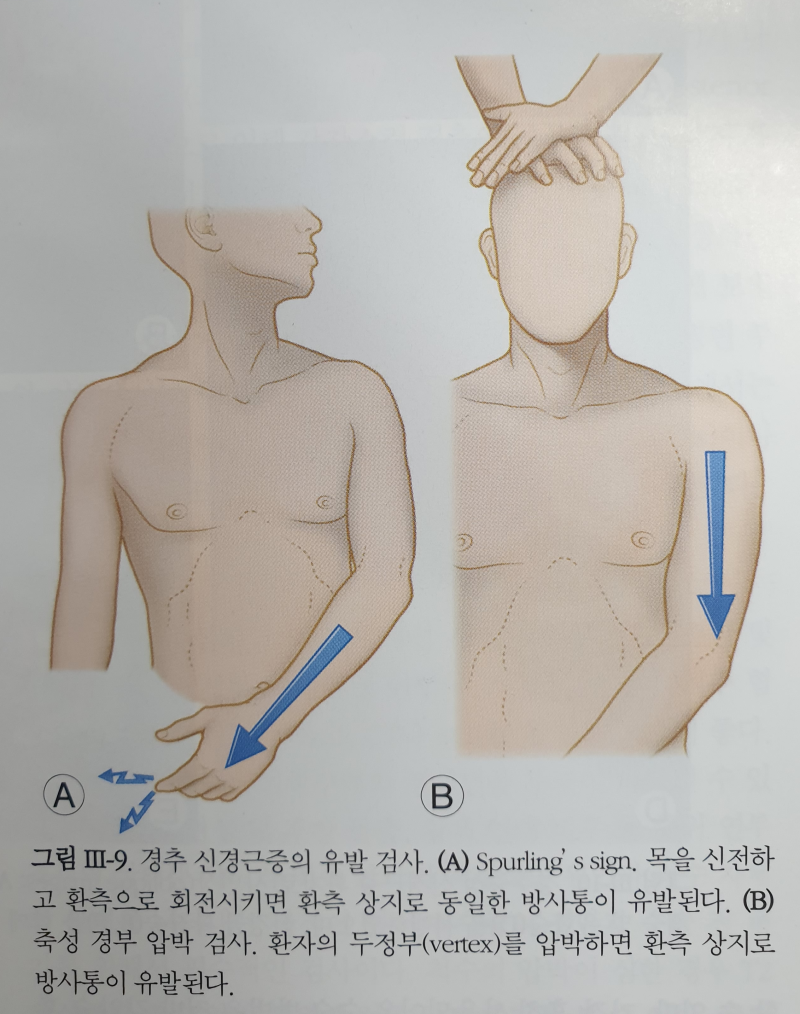 경추 신경근증, 