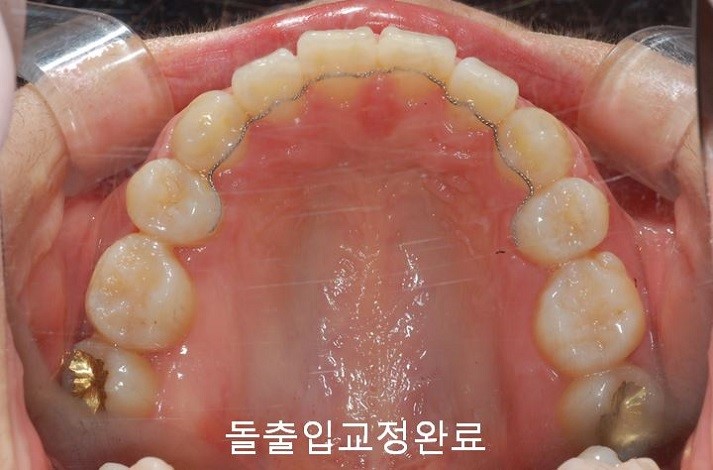 치아교정) 유지장치는 평생 해야 한다? : 네이버 블로그