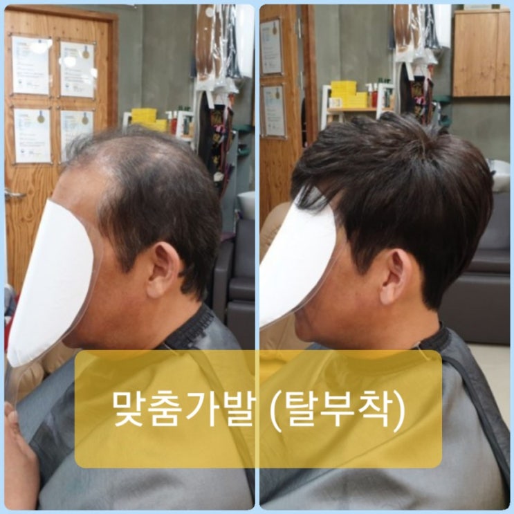  탈모의 종류와 증상을 알아보자 [춘천가발][춘천가발전문점]