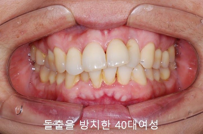 치아교정) 유지장치는 평생 해야 한다? : 네이버 블로그
