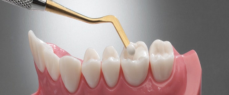 삼송치과 치아 충전재 종류