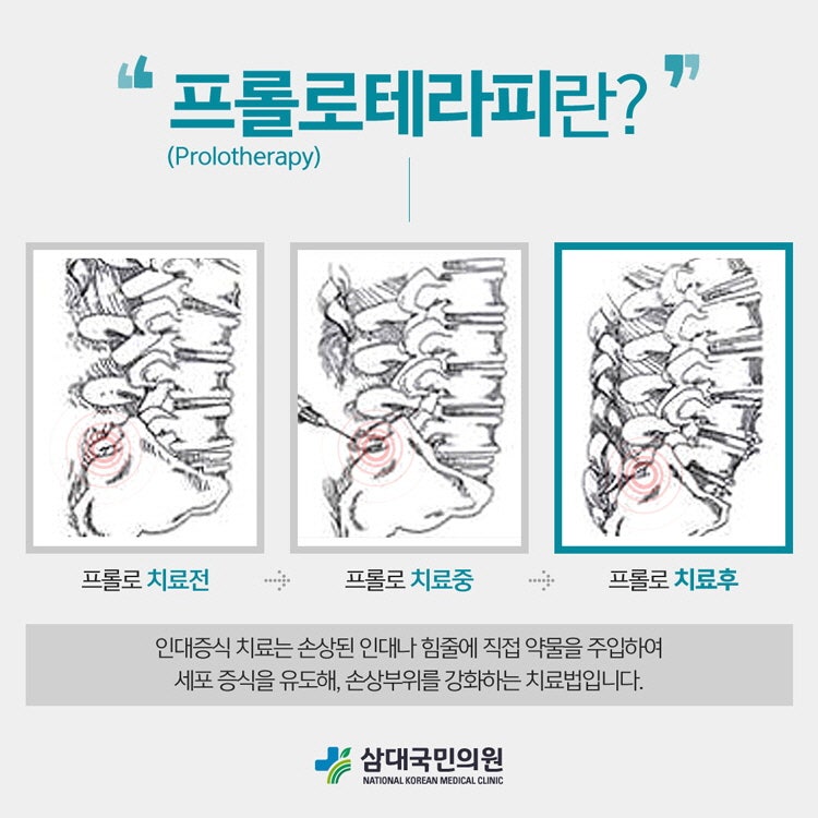 프롤로치료가격? 저렴한 곳 찾다 통증 더 악화된 환자 특징 10