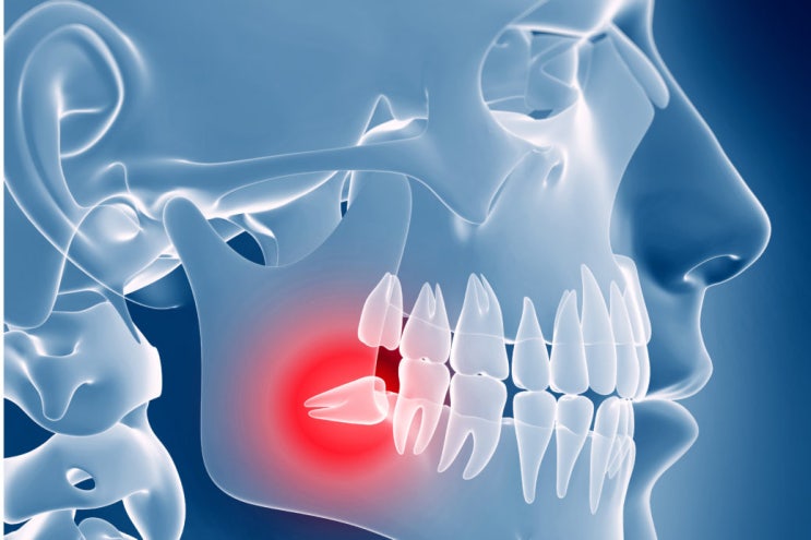 삼송역 치과 사랑니 발치 이유