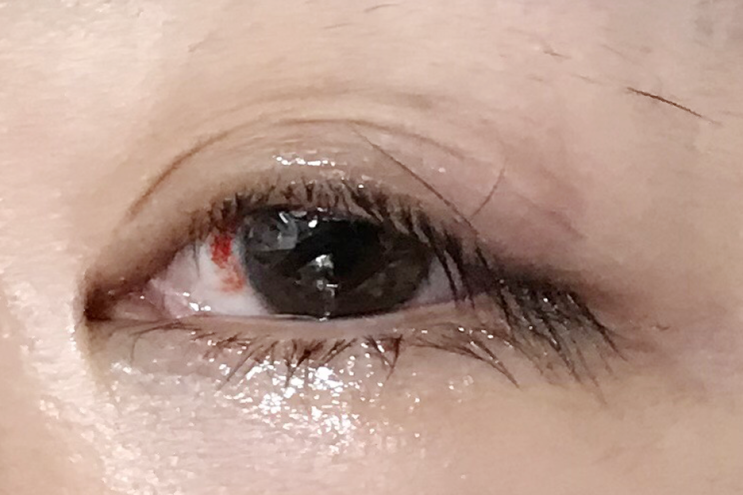  콩 다래끼 수술 후기 ㅠㅠ 방치하면 안됨