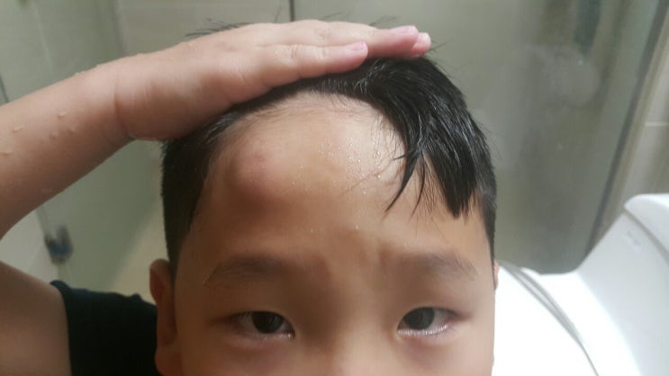 베트남 하노이 막내 아이 이마에 혹이 났어요 ㅜㅜ 베트남 하노이 막내 아이 이마에 혹이 났어요 ㅜㅜ