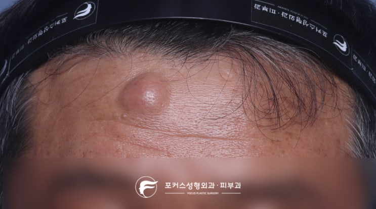  [부천성형외과 Dr. 김 칼럼] 이마의 혹