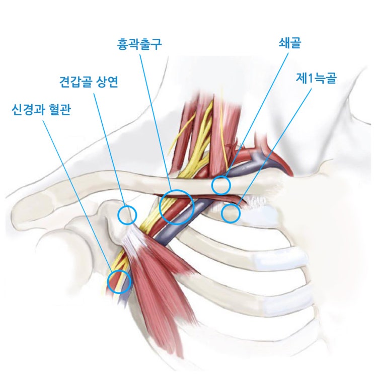 [흉곽출구 증후군] 목디스크? 오십견? 어깨통증과 손, 팔 저림의 원인과 치료 (1)