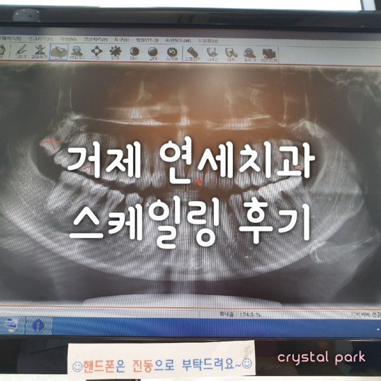  거제 연세치과 확장이전 할인이벤트 중, 스케일링 받은 후기ㅋㅋ