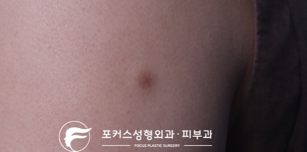  [부천성형외과 Dr. 김 칼럼] 팔에 있는 혹