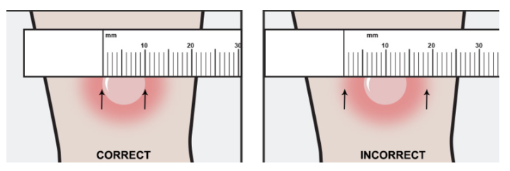 결핵검사 PPD skin test (TST검사)시행-강남대치동유학생검진 : 네이버 블로그