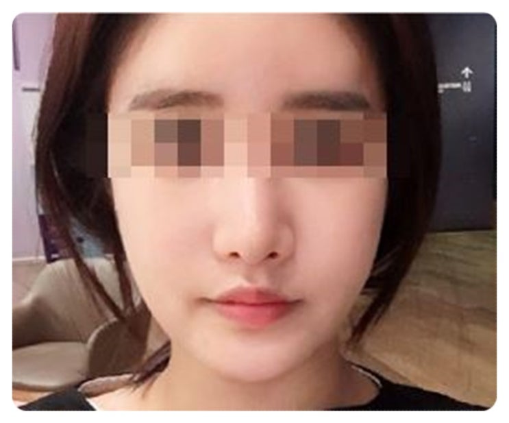  윤곽주사후기 리얼리뷰! 후기에 대한 모든것~ @@