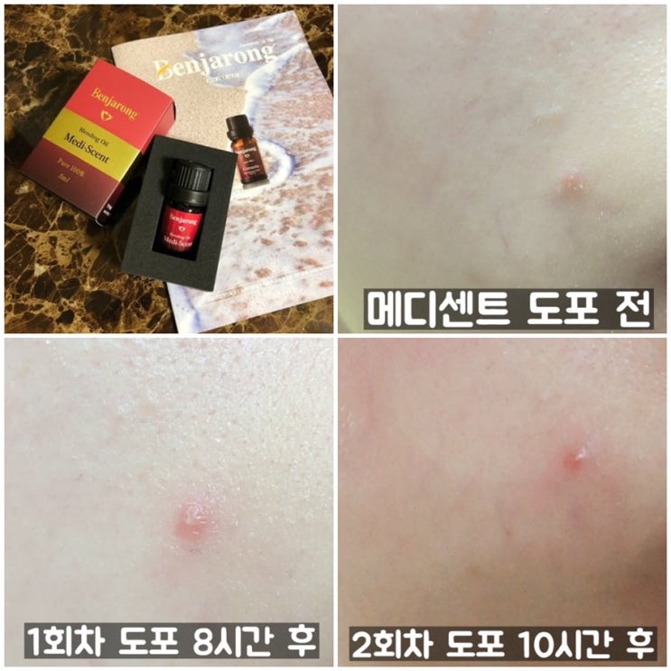  천연아로마오일 <벤자롱 메디센트> 저의 트러블,여드름치료제 ! 티트리오일&라벤더오일 강추해요