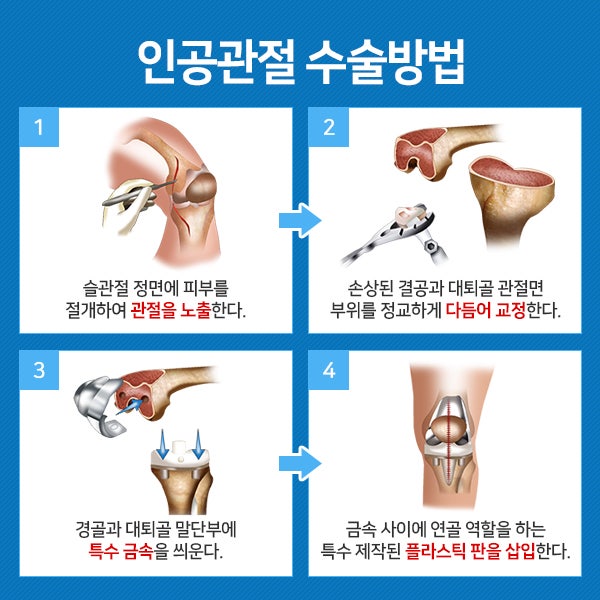 무릎 인공관절 수술을 잘하는 곳을 파악하고 신중하게 선택해야 한다