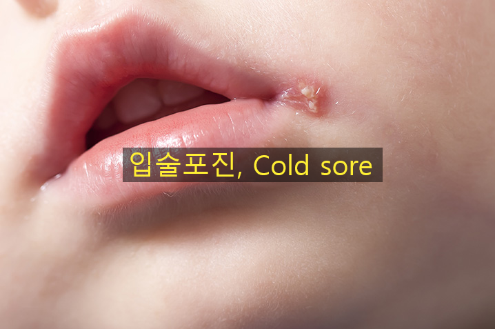 구순포진, 입술포진 빨리 낫는법,