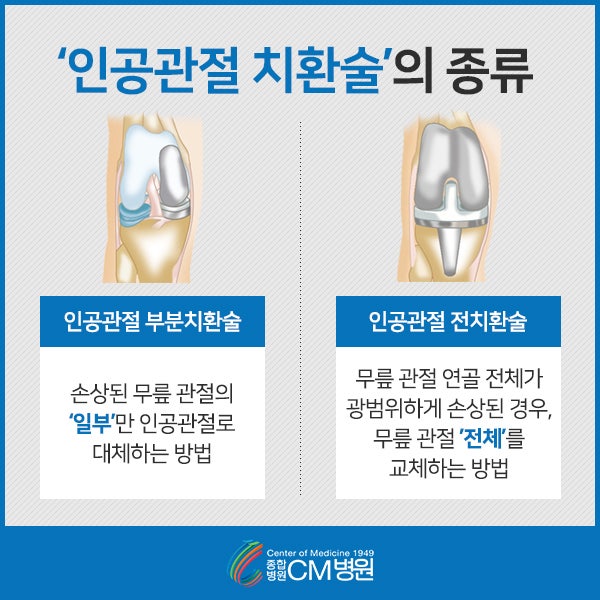 무릎 퇴행성 관절염 증상과 단계별로 적용할 수 있는 인공관절 수술 3