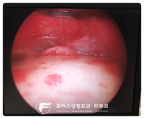  [부천성형외과 Dr. 김 칼럼] 이마의 딱딱한 혹