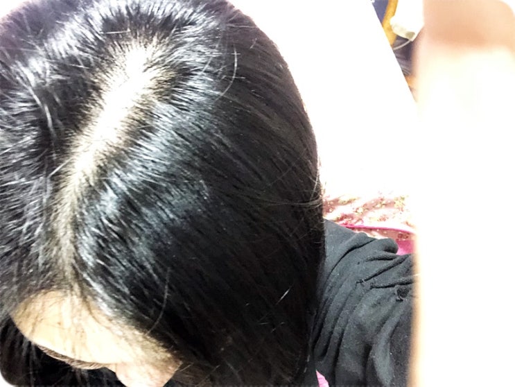  여성 정수리 탈모 이하늬 샴푸 보다 효과x3