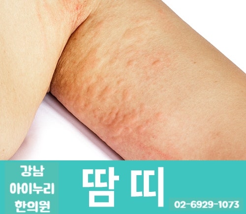 강남아토피 증상이 심하게 퍼져간다면